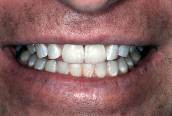 Full mouth restoration dentistry